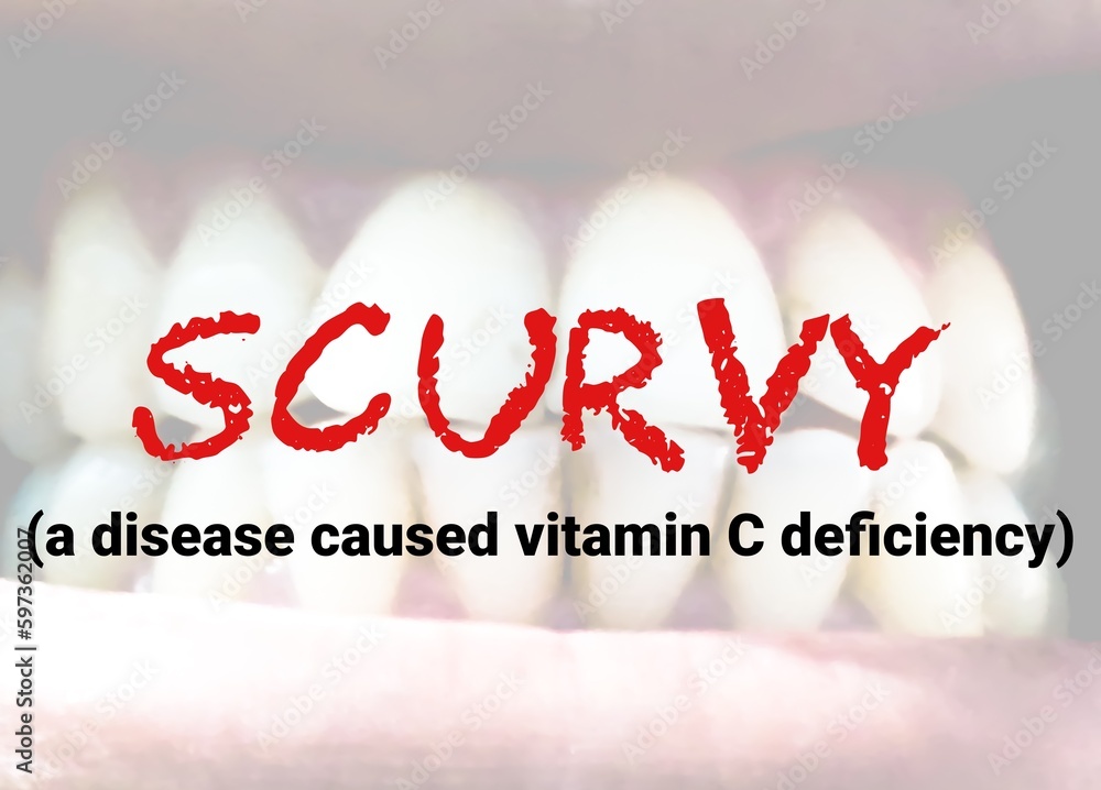 Scurvy, caused by severe vitamin C deficiency, health concept. Medical conceptual image Stock