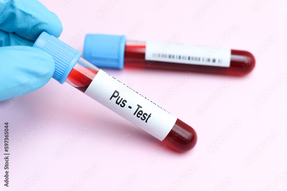 Obraz premium Pus test, blood sample to analyze in the laboratory