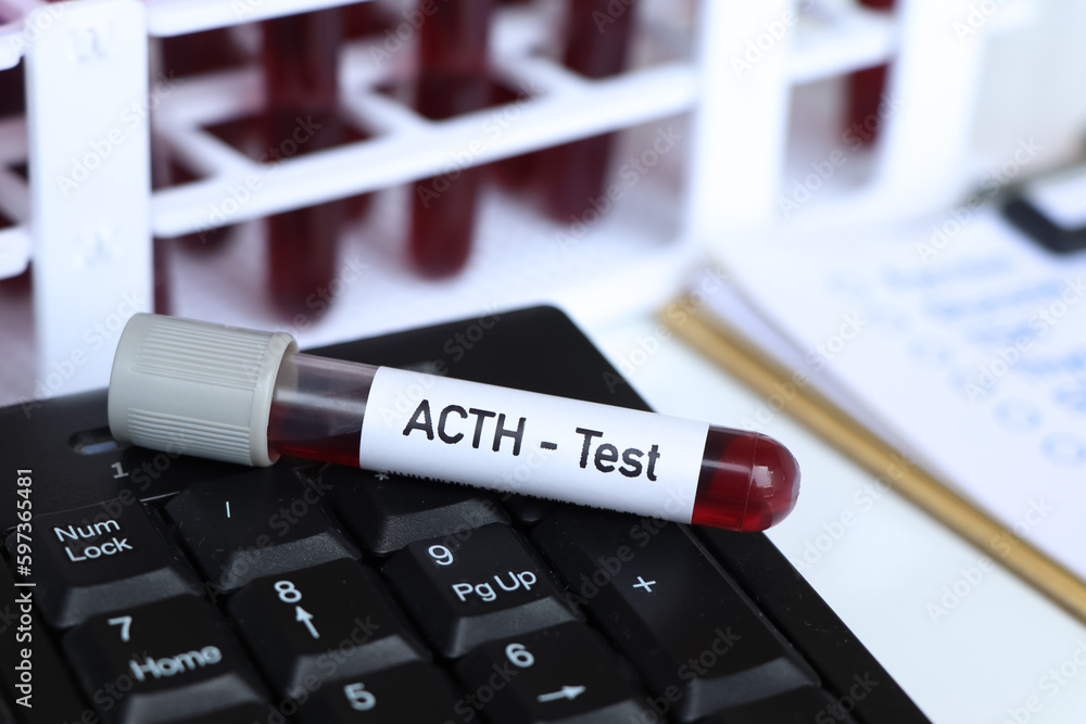 ACTH test, blood sample to analyze in the laboratory Stock Photo