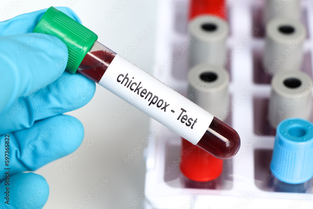 Obraz premium chickenpox test, blood sample to analyze in the laboratory