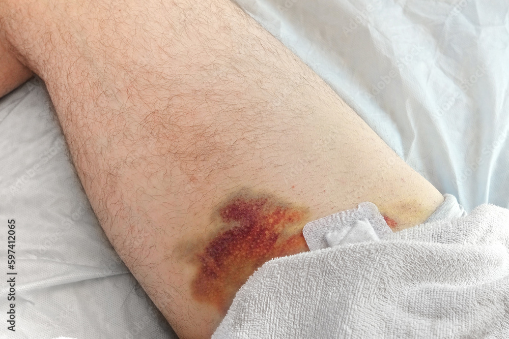 Hematoma on a men's leg close-up. Huge bruise on the leg of a man after endovascular repair due to taking blood thinning medication drugs. Doctor's hand in blue gloves examining patient. Hemorrhage Hematoma on a men's leg close-up. Huge bruise on the leg of a man after endovascular repair due to taking blood thinning medication drugs. Doctor's hand in blue gloves examining patient. Hemorrhage