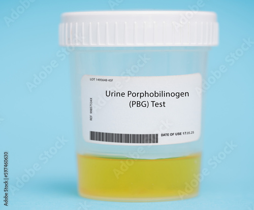 Urine porphobilinogen (PBG) test photo