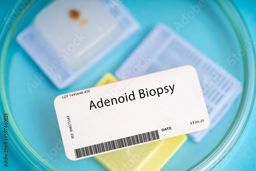 Adenoid Biopsy photo