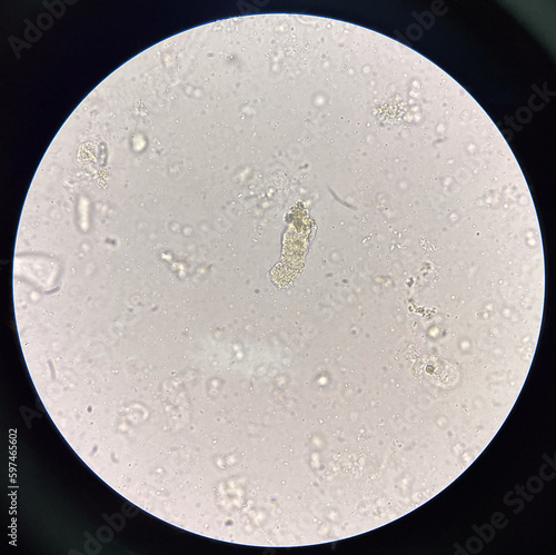 Cast in fresh urine finding with microscope.