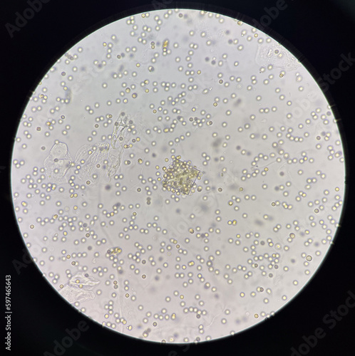 Photos Calcium oxalate crystal in urine with moderate red blood cell.