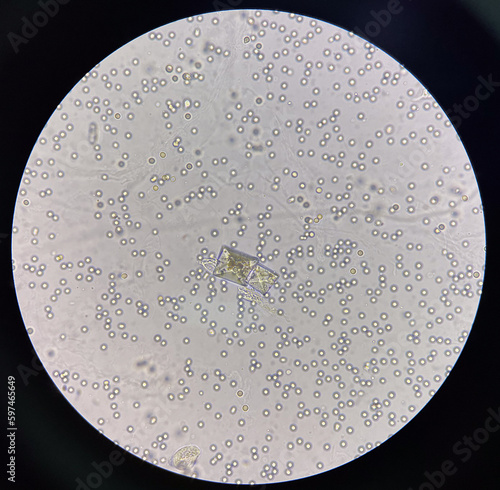 Calcium oxalate crystal in urine with moderate red blood cell. photo