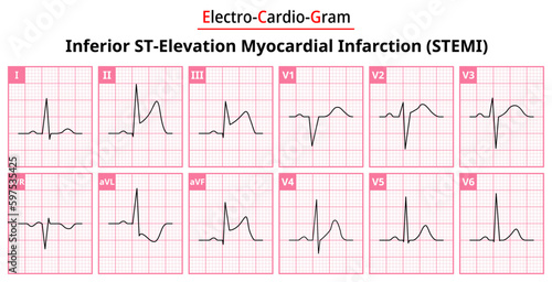 Inferior STEMI (ST-Elevation Myocardial Infarction) - The Differences in ECG Waveform for Each of the 12 Leads - Vectors and Illustrations for Medical Purposes