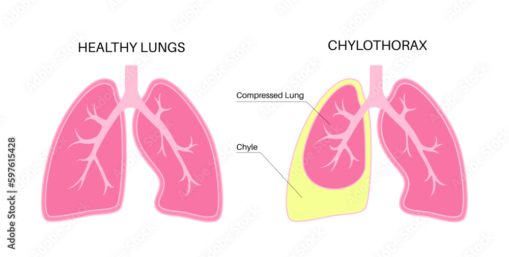 Chylothorax anatomical poster