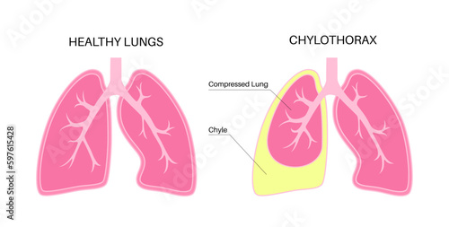 Chylothorax anatomical poster