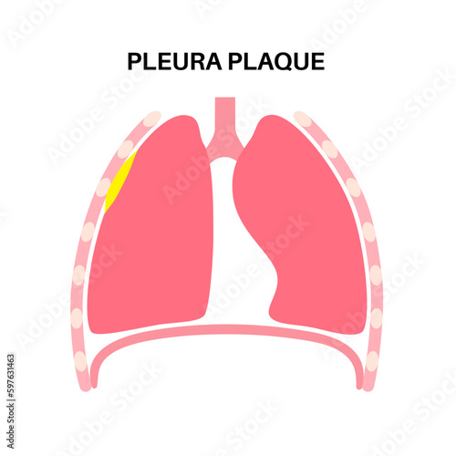 Pleural plaque poster