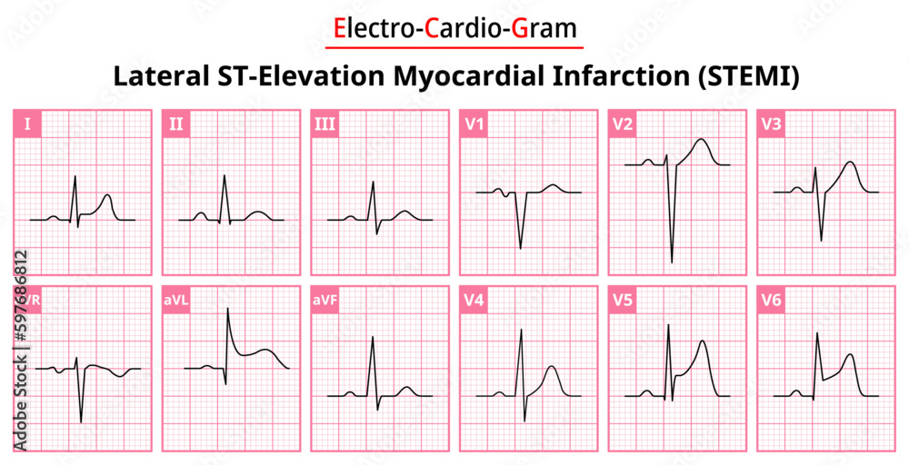 Lateral STEMI (ST-Elevation Myocardial Infarction) - The Differences in ECG Waveform for Each of the 12 Leads - Vectors and Illustrations for Medical Purposes