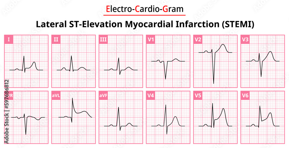 Lateral STEMI ST Elevation Myocardial Infarction The Differences In Lateral STEMI ST Elevation Myocardial Infarction The Differences In