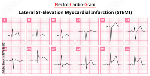 Lateral STEMI (ST-Elevation Myocardial Infarction) - The Differences in ECG Waveform for Each of the 12 Leads - Vectors and Illustrations for Medical Purposes