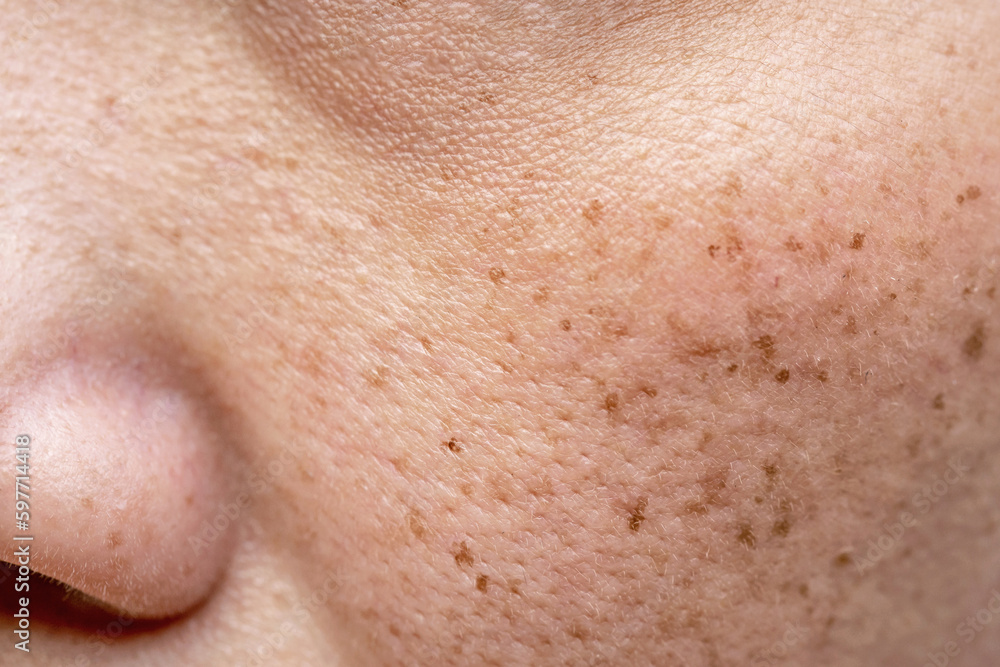 Woman's problematic skin pore and dark spots on the face Woman's problematic skin pore and dark spots on the face