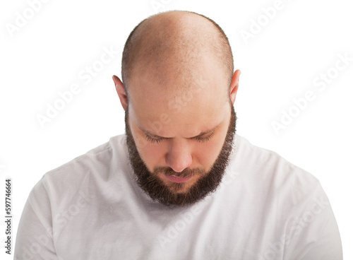 Hair loss treatment concept. Bald man