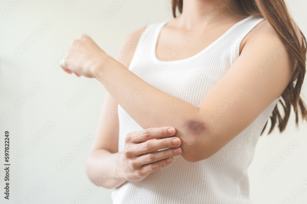 Close up of stain bruise wound on arm, contusion asian young woman