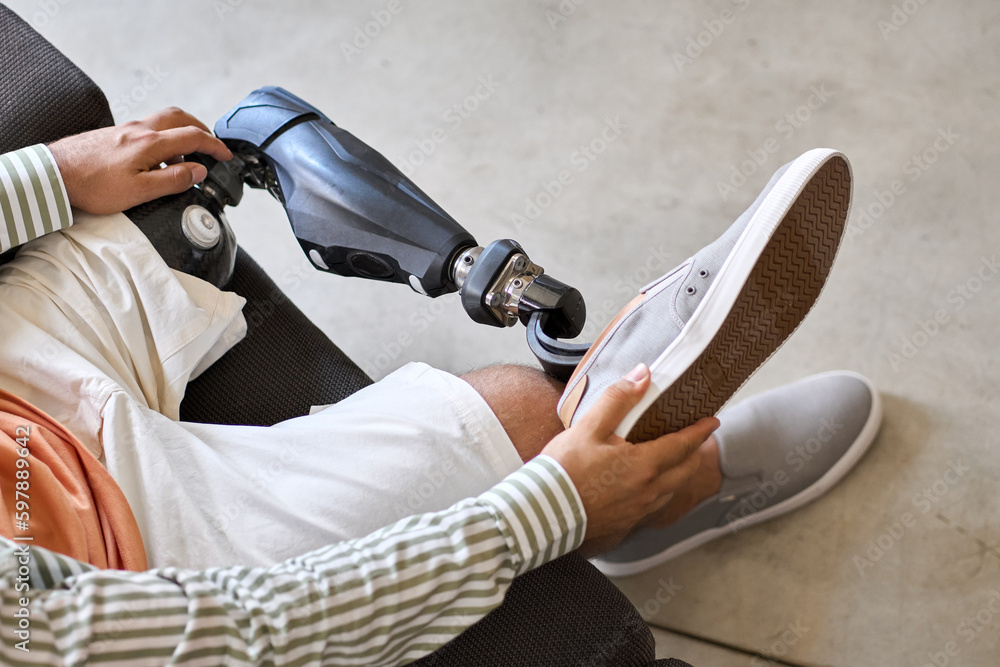Man amputee with prosthetic leg disability on above knee transfemoral ...