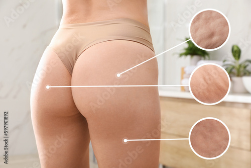 Cellulite problem. Slim woman in underwear at home, closeup. Zoomed skin areas with orange peel syndrome photo