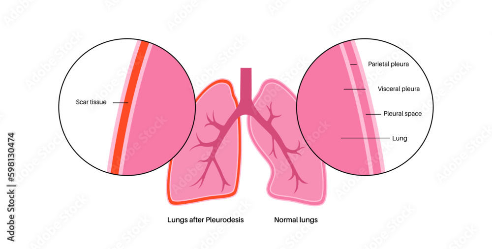 Fototapeta premium Pleurodesis medical procedure Generative AI