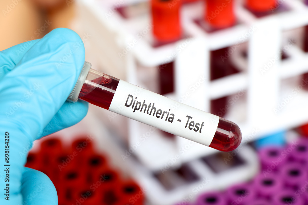 Diphtheria test, blood sample to analyze in the laboratory Diphtheria test, blood sample to analyze in the laboratory