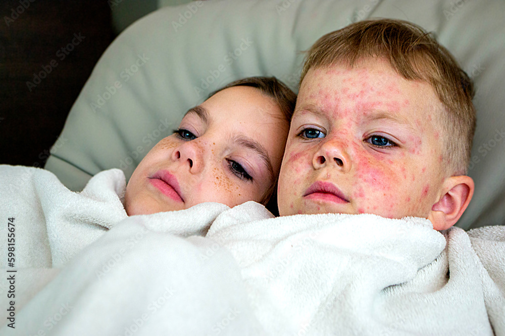 Natural vaccination between brother and sister. Contagious disease