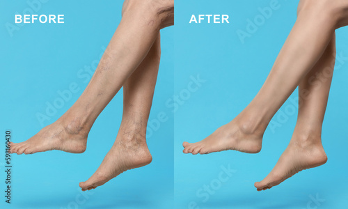 Before and after varicose veins treatment. Collage with photos of woman showing legs on light blue background, closeup © New Africa