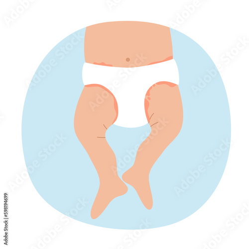 Baby diaper rash symptom in flat design.