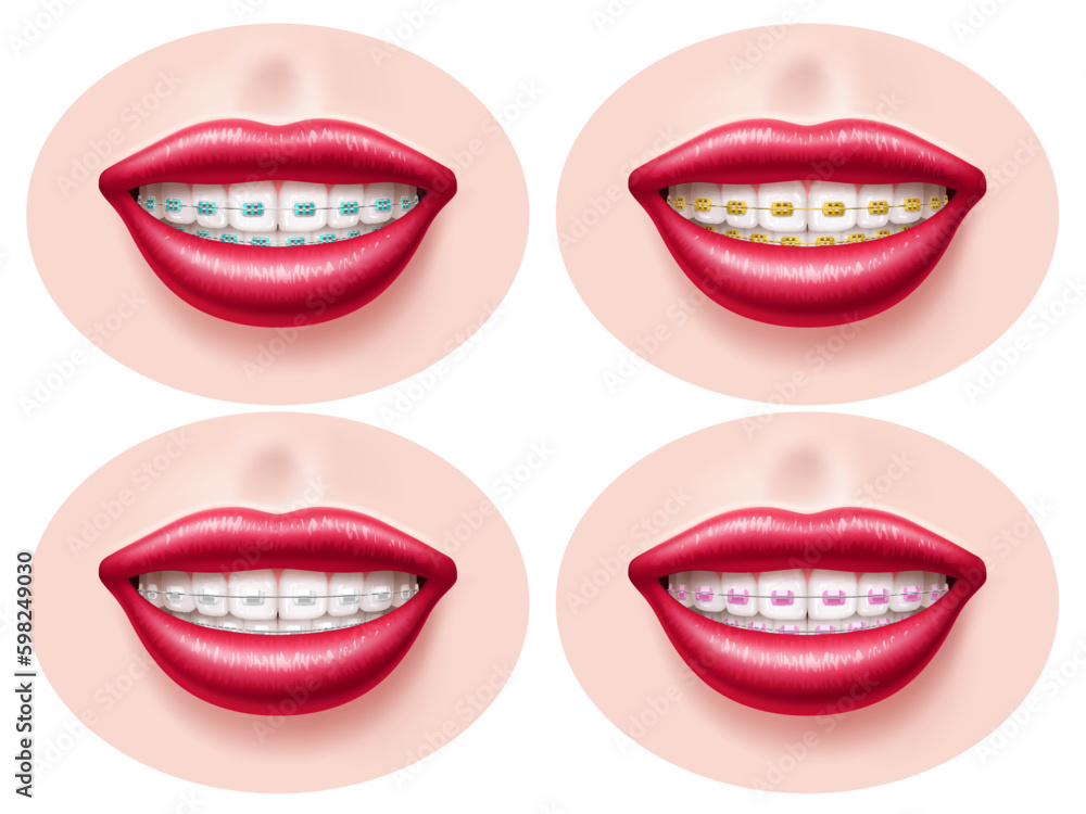 Realistic teeth dental braces. Smiling lips, orthodontic bite correction, tightening structures, different types metal, ceramic and sapphire, , health and beauty utter vector 3d isolated set Realistic teeth dental braces. Smiling lips, orthodontic bite correction, tightening structures, different types metal, ceramic and sapphire, , health and beauty utter vector 3d isolated set