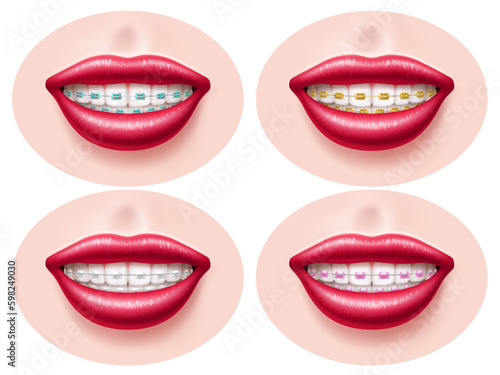 Realistic teeth dental braces. Smiling lips, orthodontic bite correction, tightening structures, different types metal, ceramic and sapphire, , health and beauty utter vector 3d isolated set