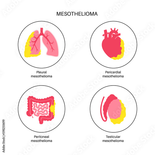 Mesothelioma tumor types Generative AI