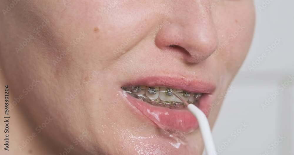 Jet of water from dental irrigator cleans female teeth with metal