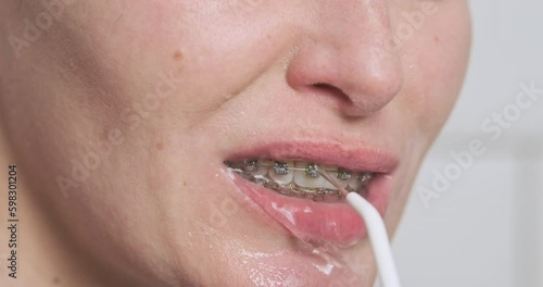 Jet of water from dental irrigator cleans female teeth with metal braces. Close-up mouth. Dental care concept, daily routine, orthodontist advice Generative AI photo