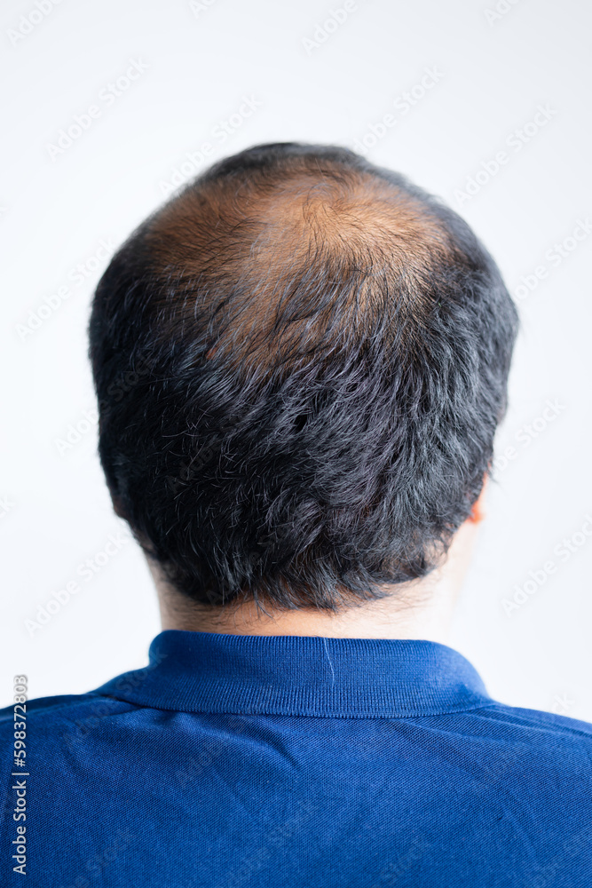 Rear side of middle aged asian man with early stage baldness and hair loss problem Rear side of middle aged asian man with early stage baldness and hair loss problem