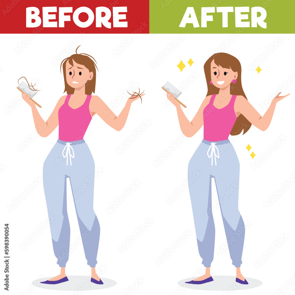 Woman before and after hair loss treatment or hair transplantation, flat vector. Woman before and after hair loss treatment or hair transplantation, flat vector.
