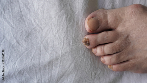 feet of a woman with a black nail. nail cancer .   nail disease    