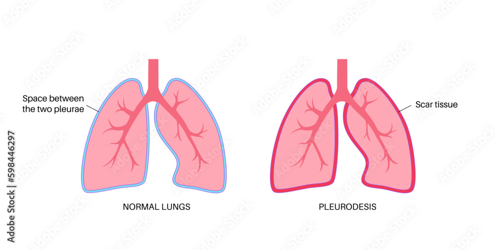 Pleurodesis medical procedure Generative AI Pleurodesis medical procedure Generative AI