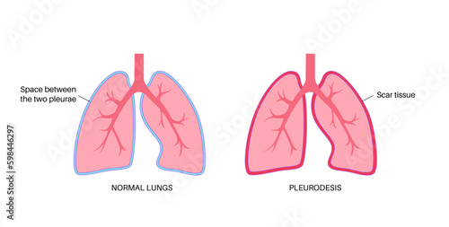 Pleurodesis medical procedure Generative AI