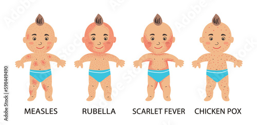 Infographics of childhood rash, measles, rubella, scarlet fever, varicella. Poster with a baby with chickenpox. Medical theme and infectious diseases of children.  photo