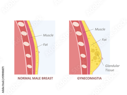 Hormone imbalance between estrogens and androgens. Gynecomastia
