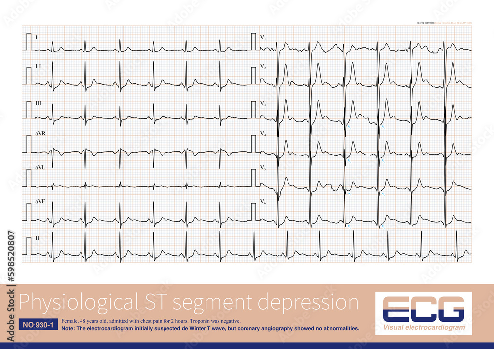 Sometimes, the ST segment of the electrocardiogram in young and middle ...