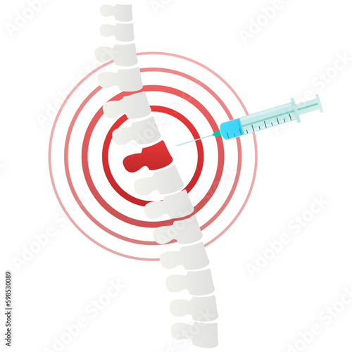 Spine joint injection. Pain and inflammation in the vertebral. Spinal arthritis disease concept. Medical research in spine center. Orthopedic therapy. Vector illustration