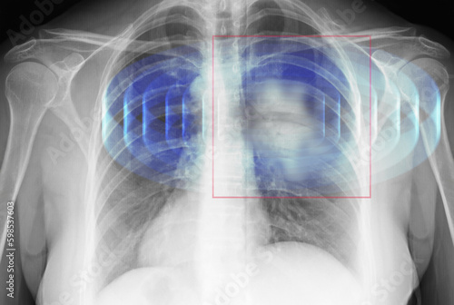 -ray of human cancer lungs photo