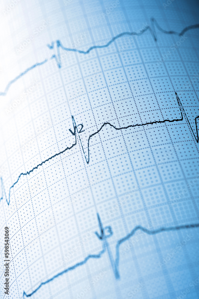 Close-up of an electrocardiogram printed on blue paper.