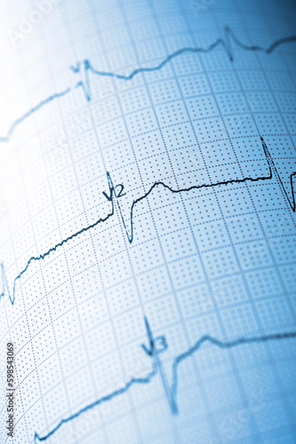 Close-up of an electrocardiogram printed on blue paper.