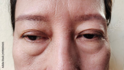 portrait the Wrinkles and Flabby skin, ptosis and blemish, dark spots and acne skin on the face of the woman, health care and beauty concept.