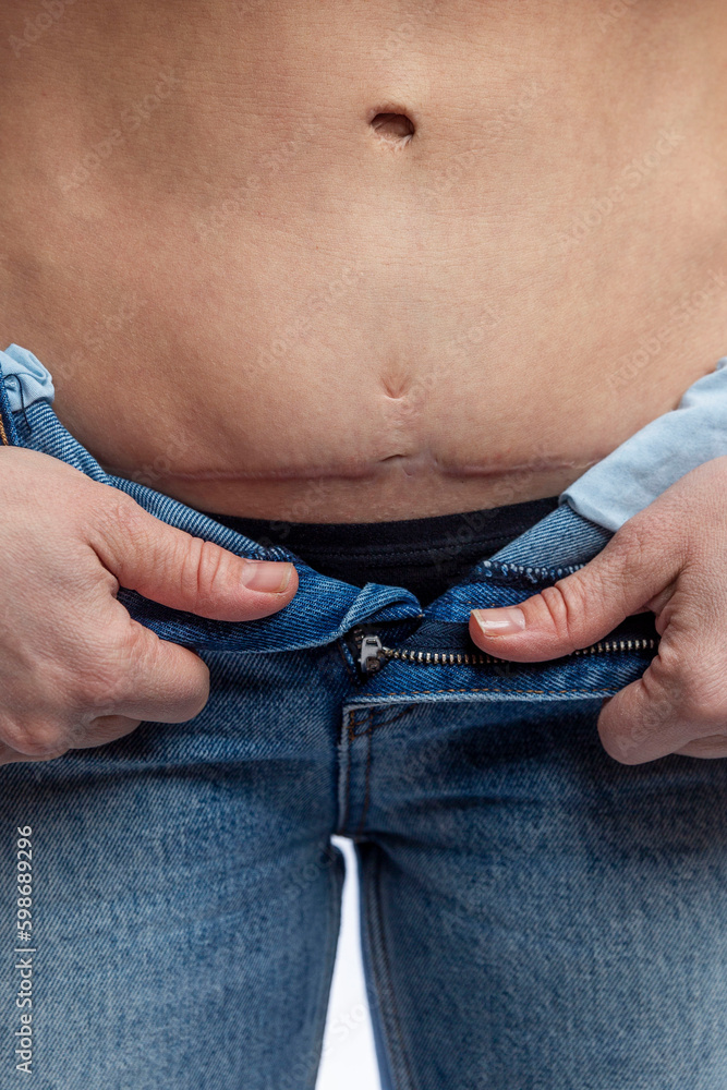A woman in jeans shows a scar on her stomach. Consequences of caesarean section and operation on