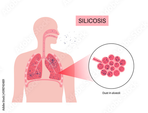 Silicosis dust in lung Generative AI