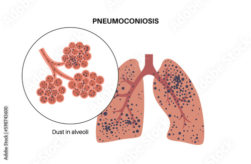 Pneumoconiosis lung disease Generative AI photo