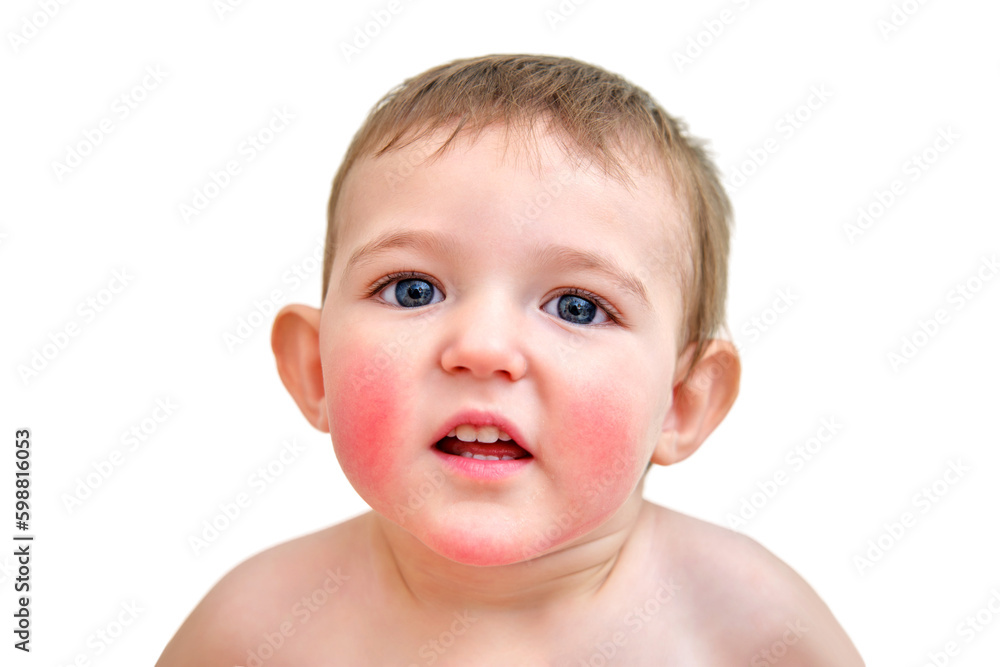 Portrait of a child with allergies on the cheeks and chin. Toddler baby boy with allergies on red face skin, white background Portrait of a child with allergies on the cheeks and chin. Toddler baby boy with allergies on red face skin, white background