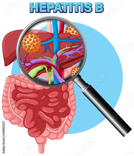 Hepatitis B liver infection virus